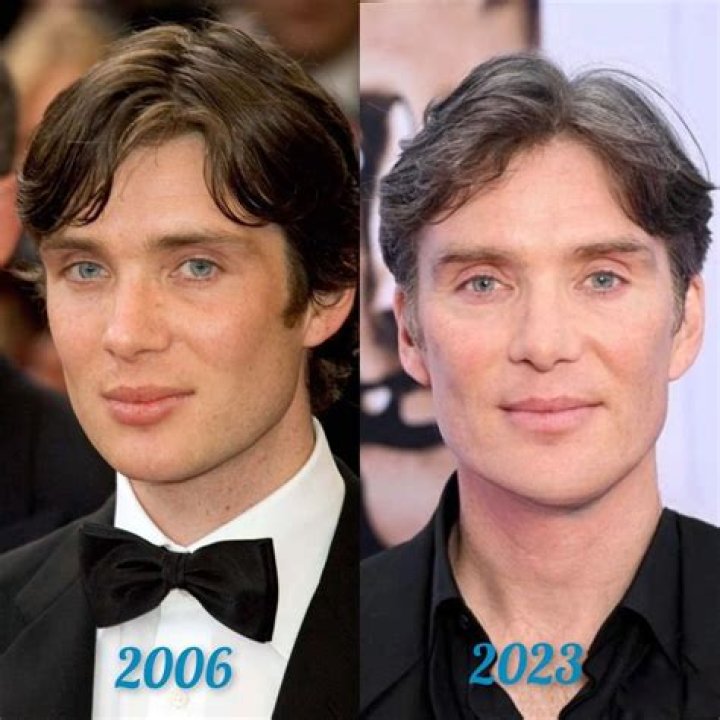 Does Cillian Murphy's Youthful Appearance Result From Botox?
