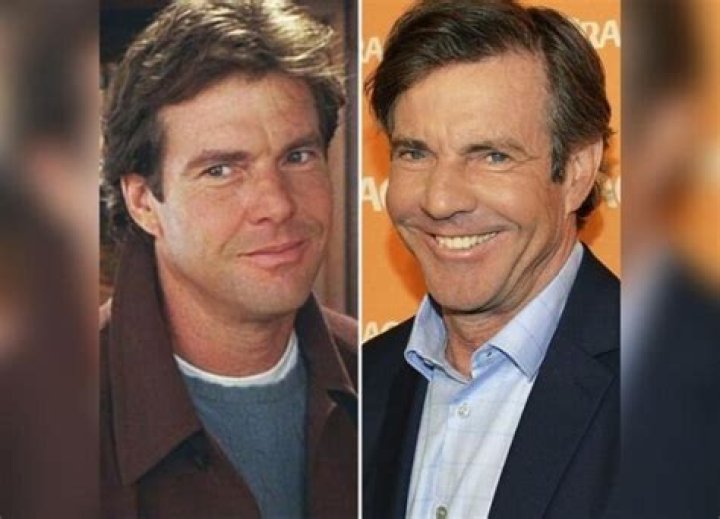 Has Dennis Quaid Embraced Plastic Surgery?
